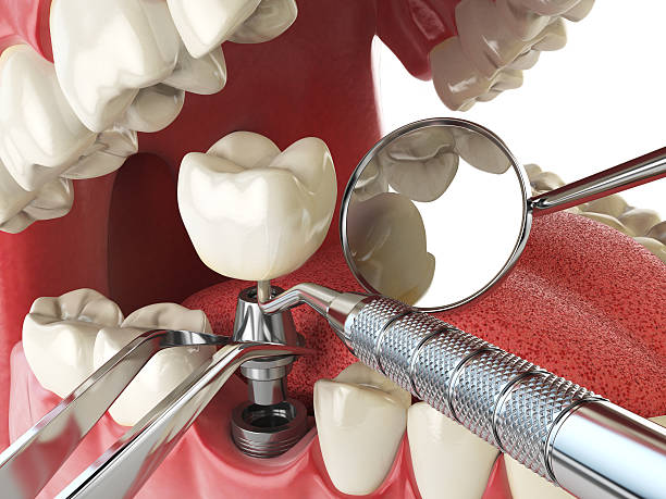 Best Emergency Tooth Extraction in Breaux Bridge, LA
